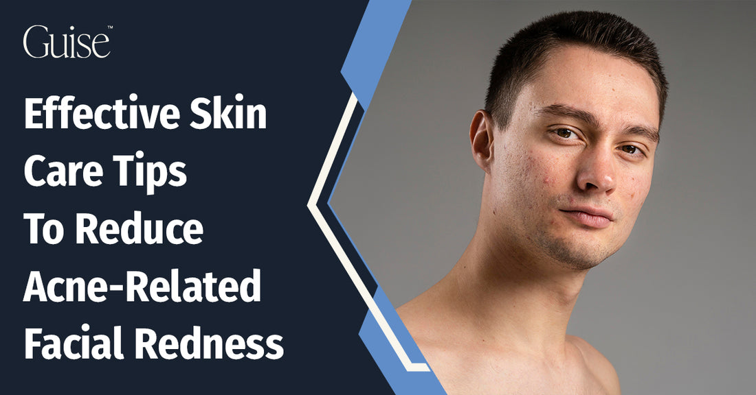 Effective Skin Care Tips To Reduce Acne-Related Facial Redness